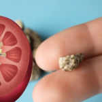 Stone analysis – what is the need